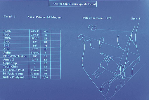 Traitement orthodontique d'un cas de classe Il 1 sans extraction