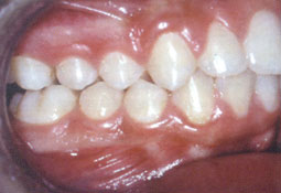 Traitement orthodontique d'un cas de classe Il 1 sans extraction