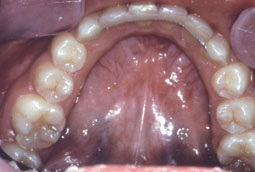 Traitement orthodontique d'un cas de classe Il 1 sans extraction