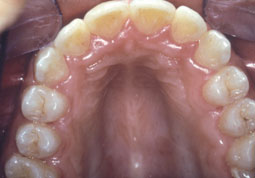 Traitement orthodontique d'un cas de classe Il 1 sans extraction