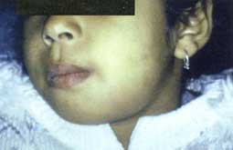 Fig. la : Aspect exobuccal d'une cellulite génienne basse chez une enfant de 5 ans