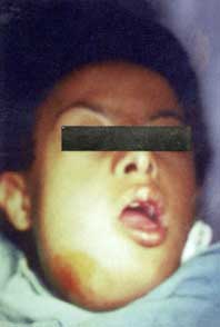 Fig. 2 : Aspect exobuccol d'une cellulite suppurée chez un enfant trisomique