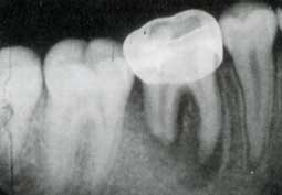 Fig. 8 : Dent nécrosée compliquée d'une lésion périradiculaire et d'une résorption pathologique des racines indiquant l'extraction de la dent