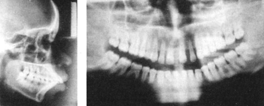 Figures 10 : La téléradiographie de profil montre la vestibuloversion importante des incisives. La panoramique confirme les lyses osseuses au niveau incisif et molaire