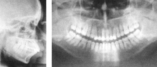 Figures 11 : La téléradiographie de profil après traitement montre la réduction de la vestibuloversion des incisives. La panoramique montre quant à elle, qu'il n'y a pas eu d'aggravation des pertes osseuses mais au contraire un léger gain