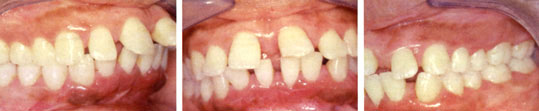 Figures 9 : Patiente en classe I molaire et canine avec vestibuloversion des dents antérieures suite à une maladie parodontale associée à une pulsion linguale.