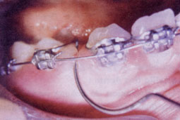 Fig. 6: Fissure gingivale puis Réouverture de l'espace d'extraction