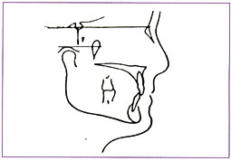 Fig. A: Croissance mandibulaire antérieur : hypodivergence