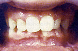 Fig. 4: Supraclusion