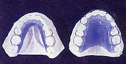 Fig. 7: Plaques de Hawley maxillaire et mandibulaire