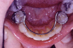 Fig. 8: Arc lingual scellé sur bagues