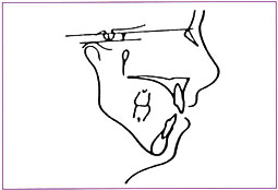 Fig. B: Croissance mandibulaire postérieure : hyperdivergence