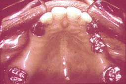 Fig. 11 : Essayage des éléments conjoints fraisés (CCTD)