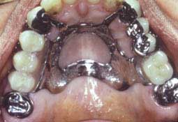 Fig. 18 :  Aspect clinique de la prothèse composite terminée (C.C.T.D)