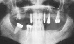 Fig. 2 : Radiographie panoramique du cas clinique (C.C.T.D)