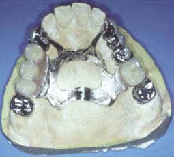 Fig. 15 : Contrôle de l'adaptation du Chassis sur les éléments de la prothèse fixée au maxillaire (C.C.T.D)
