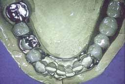 Fig. 16 : Contrôle de l'adaptation du Chassis sur les éléments de la prothèse fixée à la mandibule(C.C.T.D)