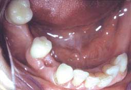 Fig. 6 : Couronnes provisoires à la mandibule au niveau de la 45 et 47 (C.C.T.D)