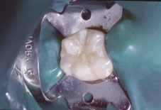 Fig. 1c : Obturation au composite Fig. 1c : Obturation au composite