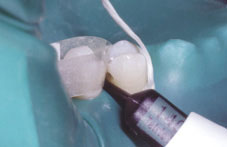 Cavité réalisée par accès direct à la lésion par la face vestibulaire cavité slot
