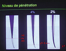 Fig. 11 : Différents niveaux de pénétration en fonction des différentes conicités