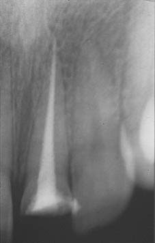 Cas clinique 1 : Traitement endodontique d’un canal facile avec instrumentation HERO Cas clinique 1 : Traitement endodontique d’un canal facile avec instrumentation HERO