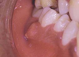 Fig. 2 : Aspect clinique d'un abcès parodontal en regard de la face vestibulaire de la 46