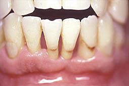 Fig. 7 : Aspect clinique d'une parodontite avec une perte d'attache et une mobilité degré 3 de la 31