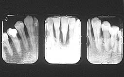 Fig. 8 : Aspect radiographique d'une lesion terminale au niveau  de la 31