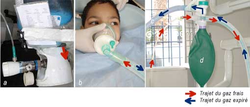 Fig 4:  circuit d’administration-évacuation (Mappelson-D modifié, Intersurgical®)