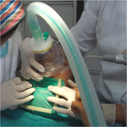 Fig 6: La digue assure non seulement un travail de  qualité, mais incite également le patient à ventiler par le nez et réduit la pollution atmosphérique. Soin conservateur réalisé sous sédation par inhalation