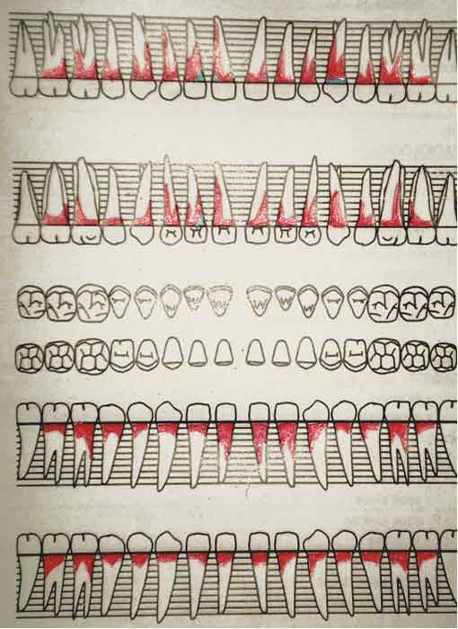 Fig 3: scharting parodontal visualisant la répartition et la profondeur des pertes d’attaches