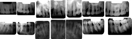 Fig 4: Bilan radiographique montrant une lyse osseuse généralisée à prédominance angulaire  