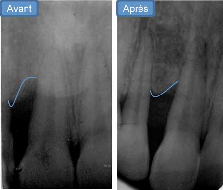 Fig 8: contrôle radiologique après 9 mois  montrant une reminéralisation de la  crête osseuse entre la 11 et 12