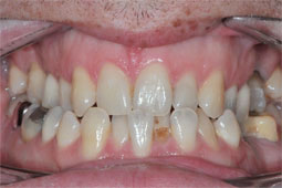 Cela valait t'il vraiment le coup pour le traitement orthodontique?