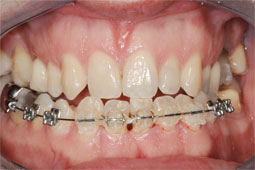 le traitement orthodontique