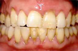 Fig 1: Vue de face montrant une inflammation gingivale généralisée avec des dépôts importants de plaque et de tartre