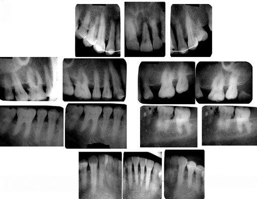 Fig 2: Bilan long cône confirmant le diagnostic d’une parodontite chronique généralisée Fig 2: Bilan long cône confirmant le diagnostic d’une parodontite chronique généralisée