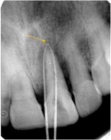 Fig 4: Radiographie deux cônes de gutta en place (cône dans la poche et cône au niveau de la fistule gingivale), les deux cones se rejoignent en apical 