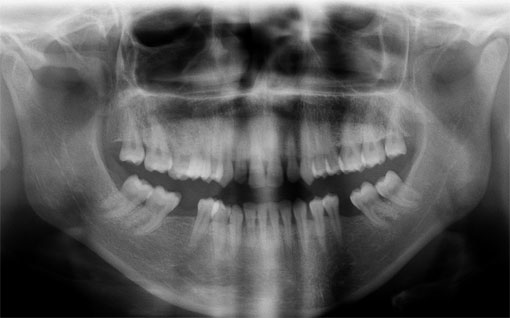 Fig3 : Radiographie panoramique