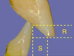 Fig.1 : Recouvrement et surplomb (6)