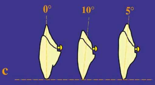 Fig.12 : Orientation des dents dans le plan sagittal (10) 