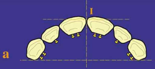 Fig.13 : Montage conventionnel maxillaire : vue horizontale (10) 