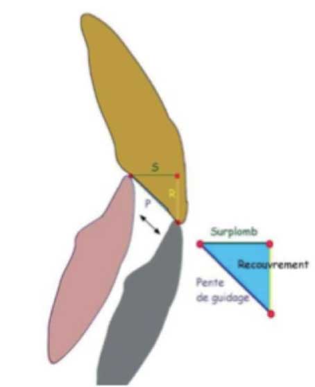 Fig.15 : Triangle de Slavicek : les paramètres de guidage sont le recouvrement, le surplomb et la pente incisive (3)