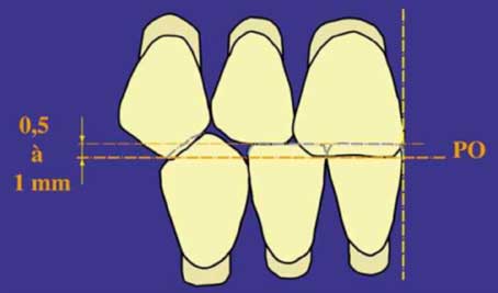 Fig.2 : Recouvrement de 0.5 à 1 mm (10)