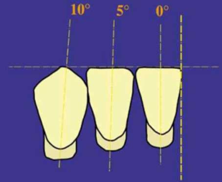 Fig.20 : Montage conventionnel mandibulaire : vue frontale (10) 