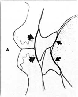 Fig.3 : Zone neutre d’après P.E.Dawson (1992) (11)