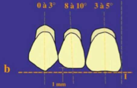 Fig.9 : Montage conventionnel maxillaire (vue frontale) 