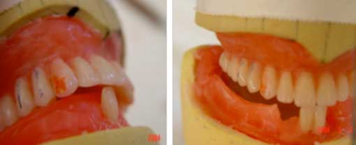 Fig.14 : Montage des incisives centrales inférieures : - Absence de contact ; - Recouvrement et surplomb n’excédant pas 2mm 