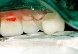 Fig. 14 : Montage des dents maxillaires : cuspides palatines sur l’axe des crêtes mandibulaire.  